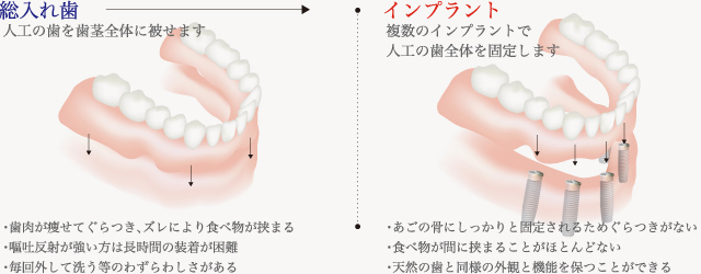 総入れ歯との比較図